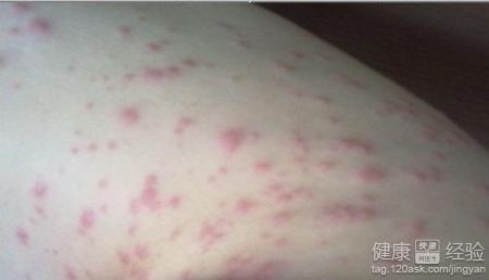 吃瓜口角过敏,揭秘夏日美食背后的健康隐患