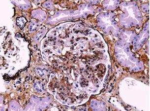 狼疮肾炎吃瓜,健康生活新篇章