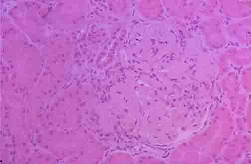 狼疮肾炎吃瓜,健康生活新篇章